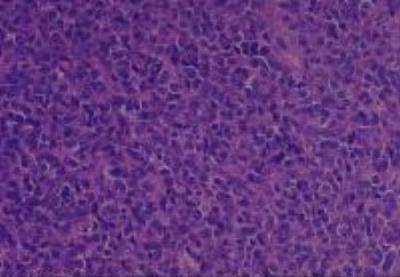 Hematoxylin & Eosin Stain: Human Melanoma Tissue MicroArray (Malignant) [NBP2-30285] - 10 Soft tissue axilla Malignant melanoma