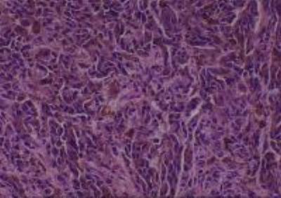 Hematoxylin & Eosin Stain: Human Melanoma Tissue MicroArray (Malignant) [NBP2-30285] - 11. Skin heel malignant melinoma
