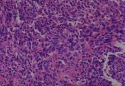 Hematoxylin & Eosin Stain: Human Melanoma Tissue MicroArray (Malignant) [NBP2-30285] -  12. Soft tissue popliteal Malignant melanoma