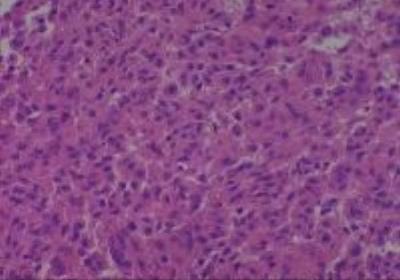 Hematoxylin & Eosin Stain: Human Melanoma Tissue MicroArray (Malignant) [NBP2-30285] -  14. Skin Axilla Metastatic Malignant