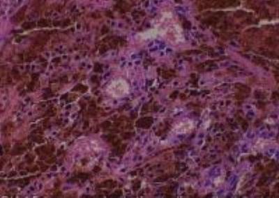Hematoxylin & Eosin Stain: Human Melanoma Tissue MicroArray (Malignant) [NBP2-30285] - 15. Lung metastatic malignant melanoma
