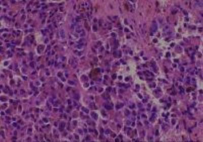 Hematoxylin & Eosin Stain: Human Melanoma Tissue MicroArray (Malignant) [NBP2-30285] - 16. Anus malignant melanoma