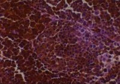 Hematoxylin & Eosin Stain: Human Melanoma Tissue MicroArray (Malignant) [NBP2-30285] - 17. Lymph node, axile metastatic malignant melanoma