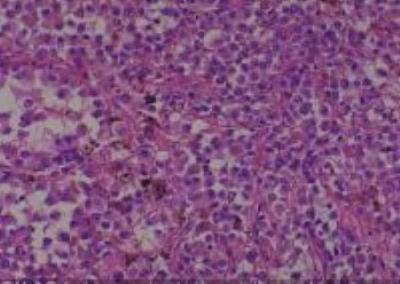 Hematoxylin & Eosin Stain: Human Melanoma Tissue MicroArray (Malignant) [NBP2-30285] - 18. Lung metastatic malignant melanoma