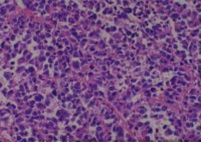 Hematoxylin & Eosin Stain: Human Melanoma Tissue MicroArray (Malignant) [NBP2-30285] - 19. Anus malignant melanoma