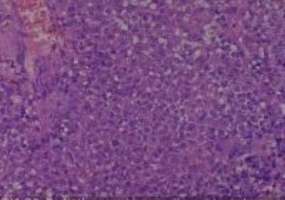 Hematoxylin & Eosin Stain: Human Melanoma Tissue MicroArray (Malignant) [NBP2-30285] -  20. Soft tissue, leg malignant melanoma