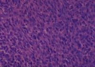 Hematoxylin & Eosin Stain: Human Melanoma Tissue MicroArray (Malignant) [NBP2-30285] -  21. Soft tissue, axilla malignant melanoma
