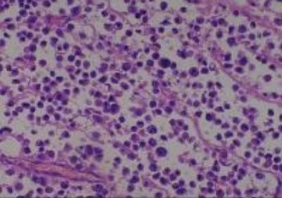 Hematoxylin & Eosin Stain: Human Melanoma Tissue MicroArray (Malignant) [NBP2-30285] -  22. Lymph node, inguinal, metastatic malignant melanoma