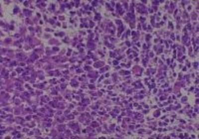 Hematoxylin & Eosin Stain: Human Melanoma Tissue MicroArray (Malignant) [NBP2-30285] -  23. Nasal cavity malignant  melanoma
