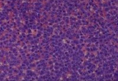 Hematoxylin & Eosin Stain: Human Melanoma Tissue MicroArray (Malignant) [NBP2-30285] -  24. Lymph node, inguinal meta static