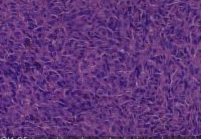 Hematoxylin & Eosin Stain: Human Melanoma Tissue MicroArray (Malignant) [NBP2-30285] -  25. Lymph node metastatic melanoma