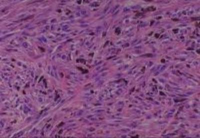 Hematoxylin & Eosin Stain: Human Melanoma Tissue MicroArray (Malignant) [NBP2-30285] -  26. skin forearm malignany melanoma