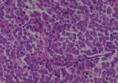 Hematoxylin & Eosin Stain: Human Melanoma Tissue MicroArray (Malignant) [NBP2-30285] -  27. Lymph node, metastatic malignant
