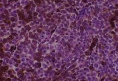 Hematoxylin & Eosin Stain: Human Melanoma Tissue MicroArray (Malignant) [NBP2-30285] -  28. Lymph node, imguinal metastatic
