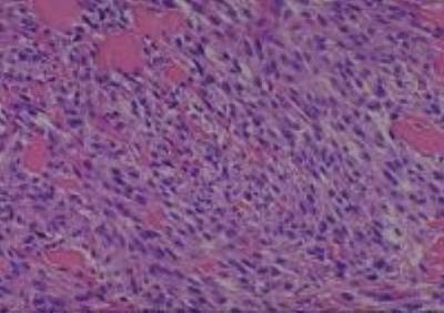 Hematoxylin & Eosin Stain: Human Melanoma Tissue MicroArray (Malignant) [NBP2-30285] -  29. Skin, leg nodular malignany melanoma