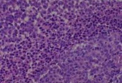 Hematoxylin & Eosin Stain: Human Melanoma Tissue MicroArray (Malignant) [NBP2-30285] - 31. Skin, axilla malignant melanoma