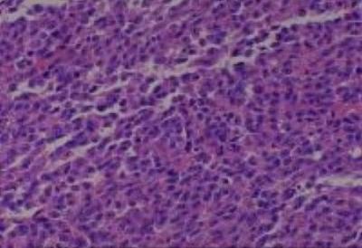 Hematoxylin & Eosin Stain: Human Melanoma Tissue MicroArray (Malignant) [NBP2-30285] -  33. Rectum, malignant melanoma