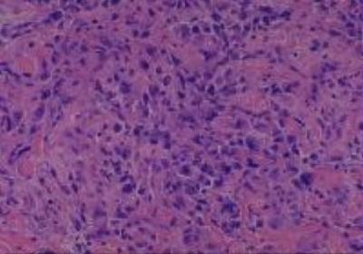 Hematoxylin & Eosin Stain: Human Melanoma Tissue MicroArray (Malignant) [NBP2-30285] -  34. Skin scalp malignant melanoma