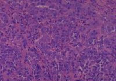 Hematoxylin & Eosin Stain: Human Melanoma Tissue MicroArray (Malignant) [NBP2-30285] -  35. Skin, back malignant melanoma