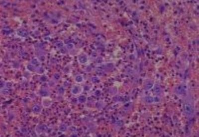 Hematoxylin & Eosin Stain: Human Melanoma Tissue MicroArray (Malignant) [NBP2-30285] - 37. Femur metastatic carcinoma