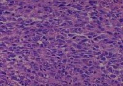 Hematoxylin & Eosin Stain: Human Melanoma Tissue MicroArray (Malignant) [NBP2-30285] - 38.  Lymph node, inguinal metastatic malignant melanoma
