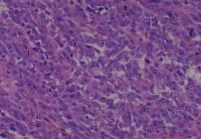 Hematoxylin & Eosin Stain: Human Melanoma Tissue MicroArray (Malignant) [NBP2-30285] - 39. Skin, big toe malignant melanoma