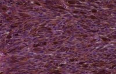 Hematoxylin & Eosin Stain: Human Melanoma Tissue MicroArray (Malignant) [NBP2-30285] -  40. Eyeball malignant melanoma
