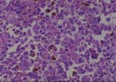 Hematoxylin & Eosin Stain: Human Melanoma Tissue MicroArray (Malignant) [NBP2-30285] -  41. Skin, lower leg malignant melanoma