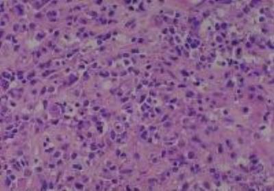 Hematoxylin & Eosin Stain: Human Melanoma Tissue MicroArray (Malignant) [NBP2-30285] - 42. Skin, face malignant melanoma