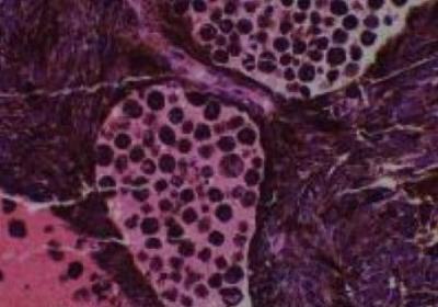 Hematoxylin & Eosin Stain: Human Melanoma Tissue MicroArray (Malignant) [NBP2-30285] - 44. Eyeball, malignant melanoma