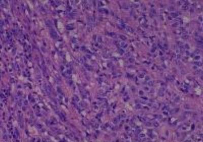 Hematoxylin & Eosin Stain: Human Melanoma Tissue MicroArray (Malignant) [NBP2-30285] -  45. Lymph node, inguinal metastatic malignant melanoma