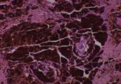 Hematoxylin & Eosin Stain: Human Melanoma Tissue MicroArray (Malignant) [NBP2-30285] -  46. Eyebell malignant melanoma