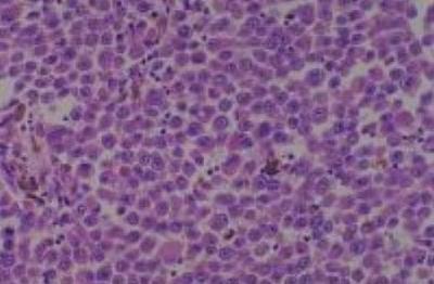Hematoxylin & Eosin Stain: Human Melanoma Tissue MicroArray (Malignant) [NBP2-30285] - 48. Lymph node, metastatic malignant melanoma