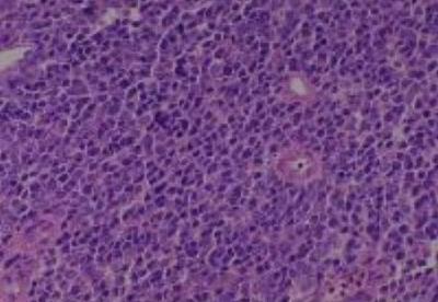 Hematoxylin & Eosin Stain: Human Melanoma Tissue MicroArray (Malignant) [NBP2-30285] -  50. Nasal cavity malignant melanoma