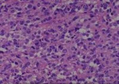 Hematoxylin & Eosin Stain: Human Melanoma Tissue MicroArray (Malignant) [NBP2-30285] -  51. Lymph node metastatic malignant melanoma