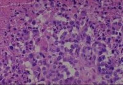 Hematoxylin & Eosin Stain: Human Melanoma Tissue MicroArray (Malignant) [NBP2-30285] - 52. Skin, forearm malignant melanoma