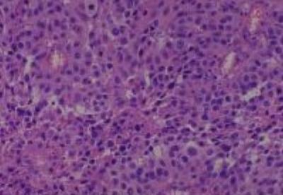 Hematoxylin & Eosin Stain: Human Melanoma Tissue MicroArray (Malignant) [NBP2-30285] -  53.Skin, thigh malignant melanoma