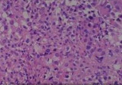 Hematoxylin & Eosin Stain: Human Melanoma Tissue MicroArray (Malignant) [NBP2-30285] - 54.Lymph node metastatic malignant melanoma