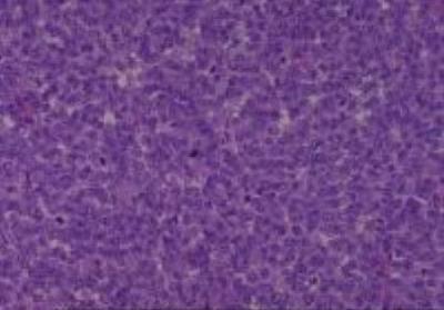 Hematoxylin & Eosin Stain: Human Melanoma Tissue MicroArray (Malignant) [NBP2-30285] - 55.Maxilla malignant melanoma