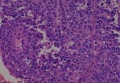 Hematoxylin & Eosin Stain: Human Melanoma Tissue MicroArray (Malignant) [NBP2-30285] - 56.Maxilla malignant melanoma