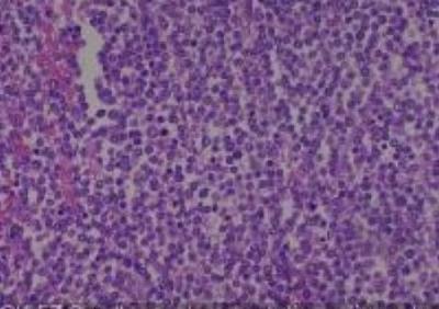 Hematoxylin & Eosin Stain: Human Melanoma Tissue MicroArray (Malignant) [NBP2-30285] - 57.Small bowel metastatic malignant melanoma