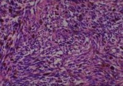 Hematoxylin & Eosin Stain: Human Melanoma Tissue MicroArray (Malignant) [NBP2-30285] -  59. Skin, sole malignant melanoma