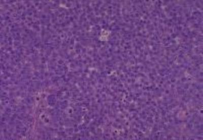 Hematoxylin & Eosin Stain: Human Melanoma Tissue MicroArray (Malignant) [NBP2-30285] -  58.Skin, inguinal malignant melanomas