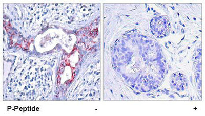 Immunohistochemistry: GSK3 beta Peptide [NB100-81948PEP] - Immunohistochemical analysis of paraffin-embedded human breast carcinoma tissue using GSK3 Beta (phospho-Ser9) antibody